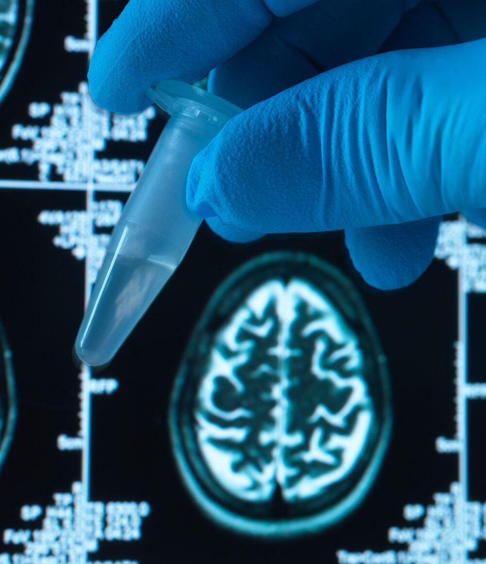 Finding a Traumatic Brain Injury Cure That Sticks